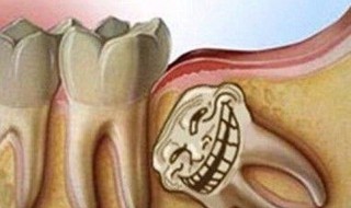 拔牙齿后要注意什么意思（拔牙齿后要注意什么意思呀）