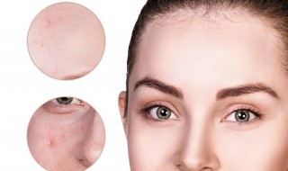 敷什么可以去痘印（敷什么可以去痘印和痘印）