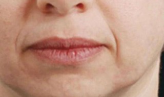 嘴周围有皱纹怎么办 嘴边有皱纹怎么办