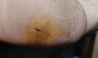 被钉子扎到脚怎么办（被钉子扎到脚怎么办自己处理）