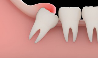 拔完智齿后很疼怎么办 拔完智齿后很疼怎么办缓解