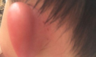 耳朵被蚊子咬了要怎么样（耳朵被蚊子咬了要怎么样止痒）