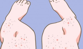 鸡皮肤怎么快速消除 鸡皮肤怎么快速消除掉