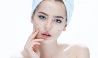 祛痘印好方法（祛痘印方法小妙招）