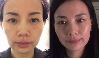 美容除皱方法（美容除皱方法有哪些）