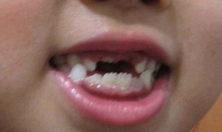 梦见自己掉牙齿（梦见自己掉牙齿掉了很多颗是什么意思 周公解梦）