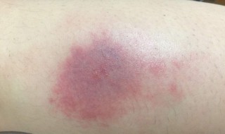 蚊子咬了红肿怎么止痒（蚊子咬了红肿怎么止痒最快）