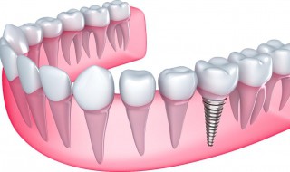 如何清洗假牙（如何清洗假牙套）