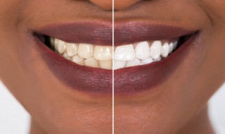 牙齿发黄怎么去除变白 牙齿发黄怎么去除变白小妙招日常