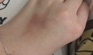 淤血怎么处理 摔倒有淤血怎么处理