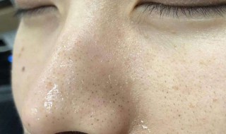 去黑头的小窍门 几个去黑头小窍门