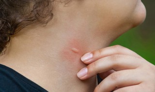 被蚊子咬后第二天起包吗（被蚊子咬后第二天才起包）