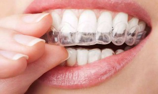 牙套适合年龄（牙套适合年龄价格多少）