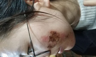 水痘坑的修复方法（水痘坑的修复方法视频）