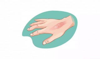 烫伤破皮后怎么处理（烫伤掉皮了用什么药最好）