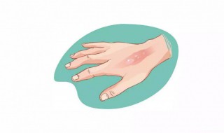 烟头烫伤后怎么处理 被烟头烫伤该怎么办