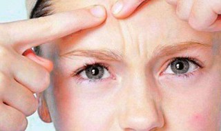 痘痘能不能去挤 痘痘怎么可以挤