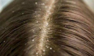 头皮里抠出的东西是什么 头皮里抠出的东西是什么