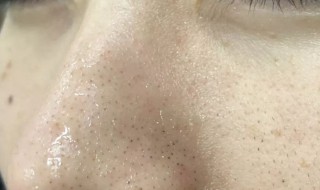 怎样去鼻子黑头 鼻子黑头怎么解决