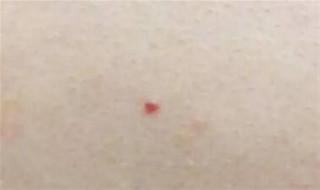 红痣代表什么 红痣代表什么寓意