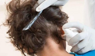 头上长虱子怎么办怎样消除（去虱子卵小妙招最快）