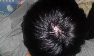 脱发了如何能让头发再生（脱发有什么好办法让头发再生）