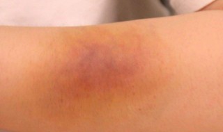 鸡蛋敷淤青正确做法（鸡蛋敷淤青正确做法视频）