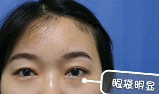 有什么祛眼袋的好方法 祛眼袋的小绝招