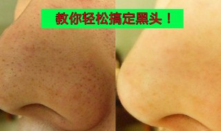 清理黑头最有效的方法 清理黑头最有效的方法视频