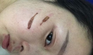 去疤去印的方法（去疤去印的方法有哪些）