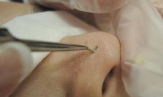 去闭口粉刺最有效的方法 去闭口粉刺最有效的方法 小红书