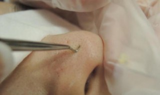 去黑头粉刺方法 去黑头粉刺的有效方法