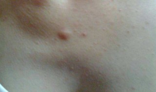 胸口长痘痘为什么 胸口长痘痘为什么会疼