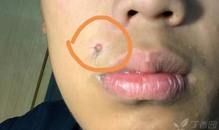 脸上哪些痣不能去掉（男生脸上哪些痣不能去掉）