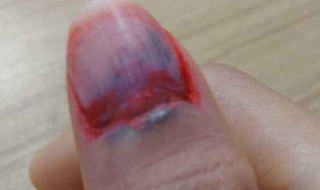 手指冷敷如何做 手指冷敷如何做视频