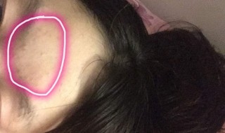 眉心重复长痘怎么处理 眉心重复长痘怎么处理图片