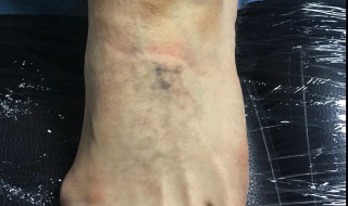 怎样消除纹身（怎样去除纹身）