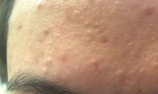 怎样祛痘痘最有效（怎样祛痘痘最有效最快）