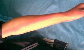 怎么消肿（怎么消肿最快方法眼睛）