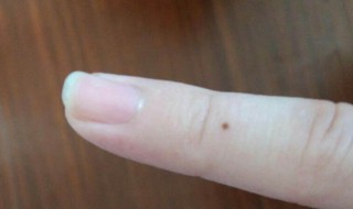 苍蝇屎在脸上怎么去掉 苍蝇屎在脸上怎么去掉小妙招图片