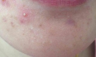 皮肤还有痘痘怎么办 皮肤还有痘痘怎么办图片