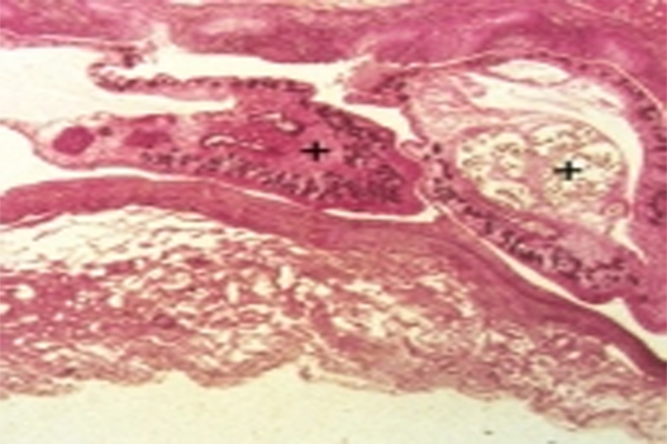 猪姜片吸虫病与华支睾吸虫病 华支睾吸虫的致病虫期