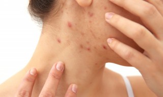 背后痘痘怎么去除 背后痘痘怎么去除效果好